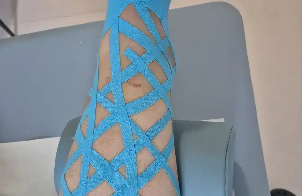 Benzi kinesio albastre aplicate pe picior – Kinesio Taping la Clinica Kinetoterapia Piatra-Neamț