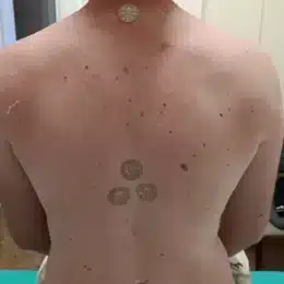 Pacient cu discuri ANF Therapy aplicate pe ceafă, coloana toracică și zona lombară – Clinica Kinetoterapia Piatra-Neamț