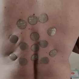 Discuri ANF Therapy aplicate pe coloana toracică și lombară, pentru durere de spate – Clinica Kinetoterapia Piatra-Neamț