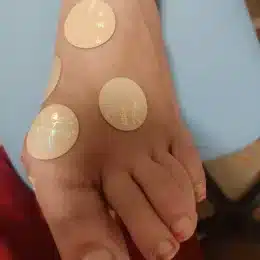 Discuri ANF Therapy aplicate pe fața dorsală a piciorului – Clinica Kinetoterapia Piatra-Neamț