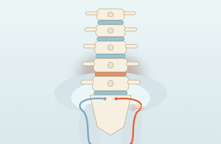 Ilustrație a coloanei lombare cu discul afectat evidențiat și traseul nervului sciatic pe un picior
