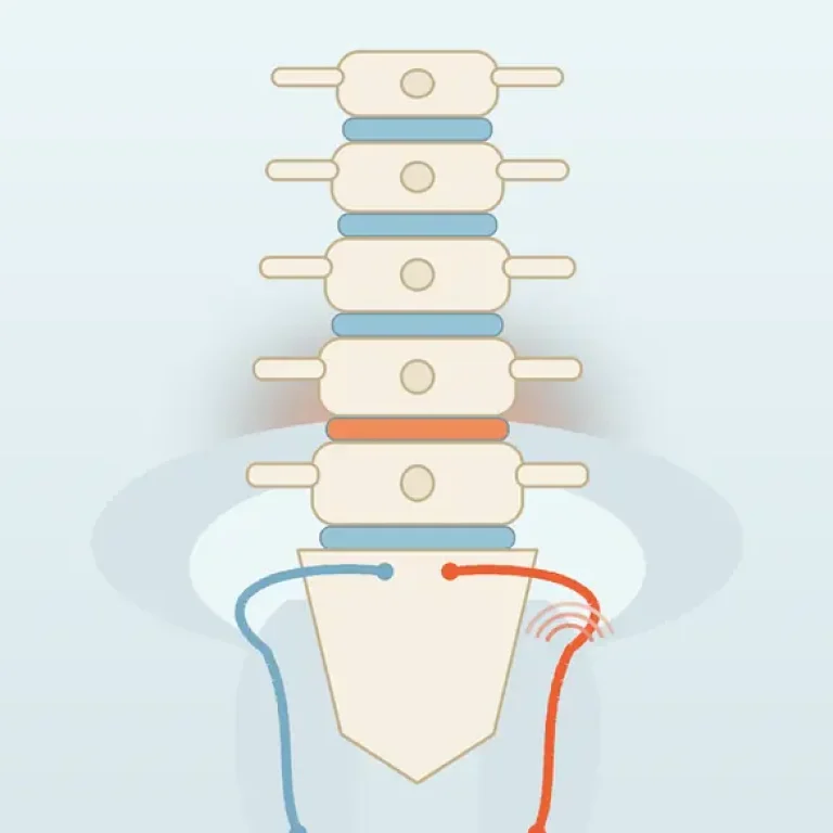 Ilustrație a coloanei lombare cu discul afectat evidențiat și traseul nervului sciatic pe un picior